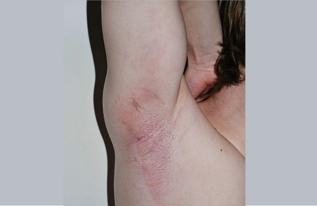 הסכנות שבהסרת שיער בלייזר שלא בידי מומחים. תמונה של בית שחי של אישה עם כוויה אדומה.