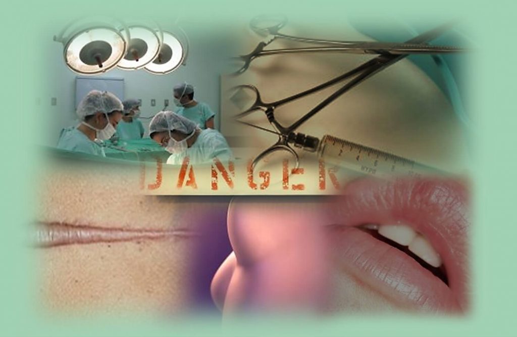 מה יכול להשתבש בניתוחים פלסטיים והזרקות?. תמונה מחדר ניתוח, מילוי שפתיים שהשתבש וצלקת קלואידית.