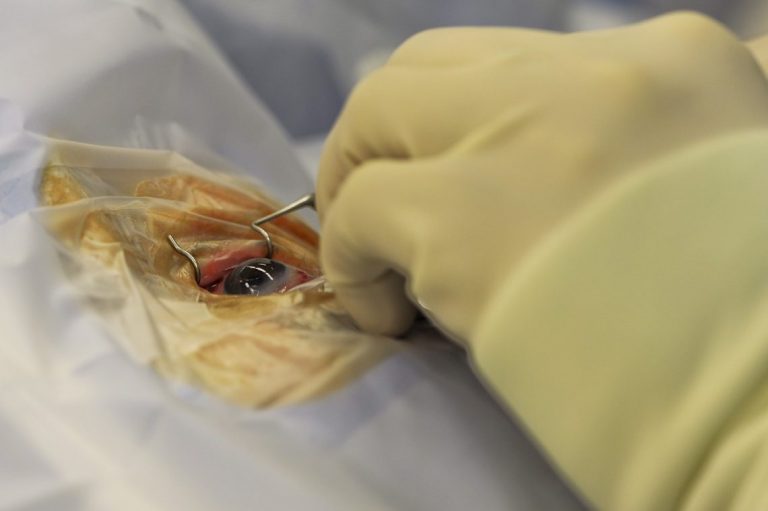 פטוזיס צניחת עפעפיים וניתוח להרמת עפעפיים עליונים.תמונה של עין מנותחת.